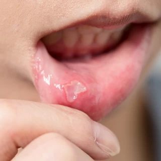 Aphthous Ulcers: What You Need to Know