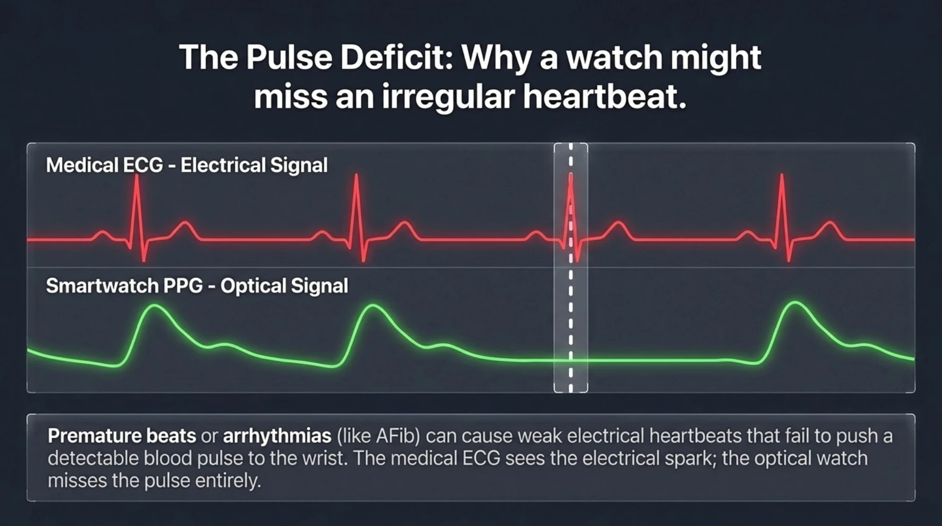 ECG and smartwatch optical pulse waveforms showing how premature beats and arrhythmias can create a pulse deficit, causing a smartwatch to miss some electrical heartbeats
